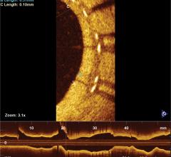 eluvia drug eluting stent mri safety